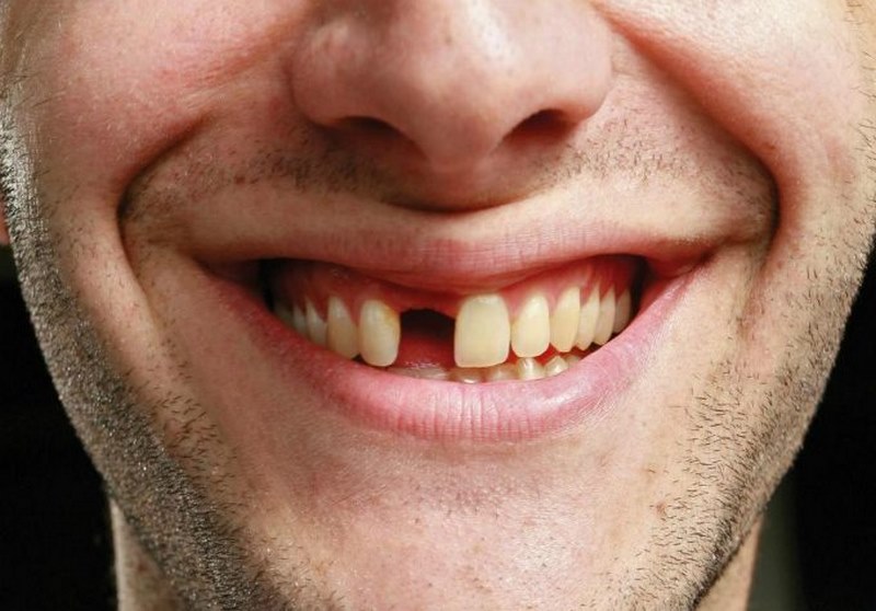 Chiêm bao thấy rụng nhiều răng là báo hiệu sắp tới bạn hao hụt về tài chính
